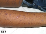 lichen planus