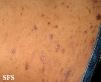 lichen planus