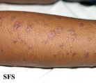 lichen planus