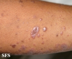 lichen planus