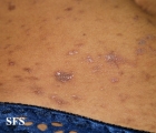 lichen planus