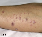 lichen planus