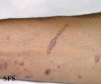 lichen planus