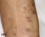 lichen planus