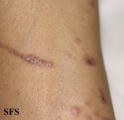 lichen planus