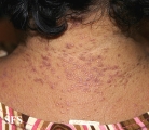 lichen planus