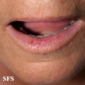 lichen planus