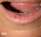 lichen planus