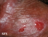 lichen planus