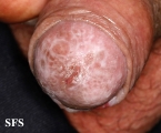 lichen planus