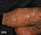 lichen planus