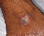 lichen planus