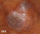 lichen planus