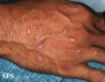 lichen planus