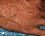 lichen planus