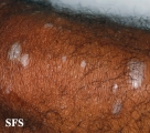 lichen planus