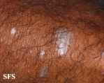 lichen planus