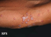 lichen planus