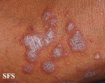 lichen planus
