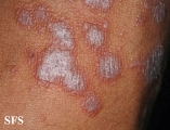 lichen planus
