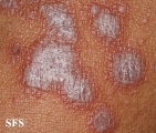 lichen planus