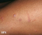 lichen planus