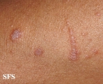 lichen planus