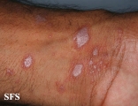 lichen planus