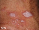 lichen planus