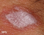 lichen planus