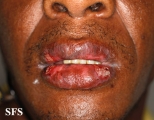 lichen planus