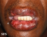 lichen planus