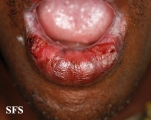 lichen planus