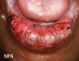 lichen planus