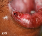lichen planus