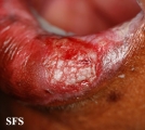lichen planus