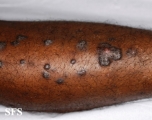 lichen planus