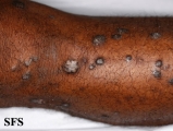 lichen planus