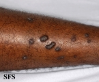 lichen planus