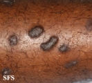 lichen planus