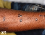 lichen planus