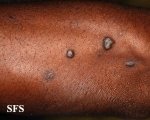 lichen planus