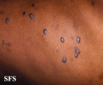 lichen planus
