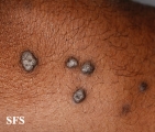 lichen planus