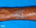 lichen planus