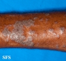 lichen planus