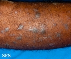 lichen planus
