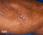 lichen planus