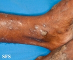 lichen planus