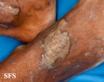 lichen planus